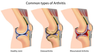 osteoarthritis-and-rheumatoid-arthritis-1000px